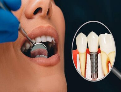 The Benefits Of Replacing Missing Teeth With Dental Implants